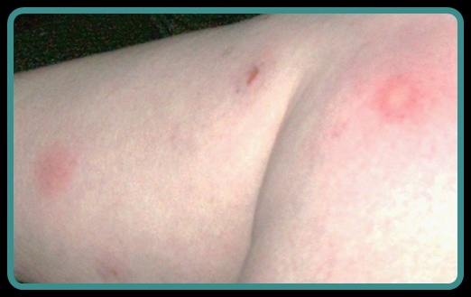 Scabies Bites Pictures On Humans